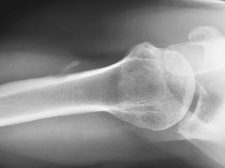 Figure 5 for case tendon of pectoralis major ( RID2007 )